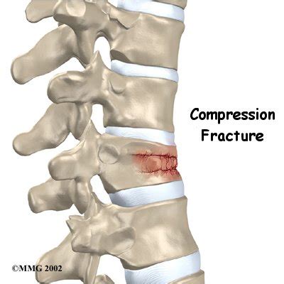 Spinal Compression Fracture | 🩺Singapore Sports & Orthopaedic Surgeon