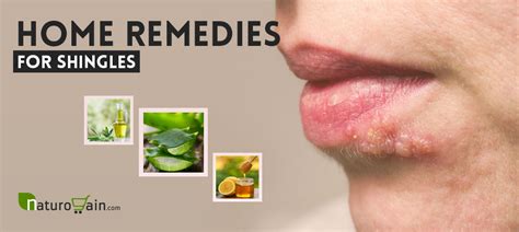 9 Effective and Best Home Remedies for Shingles