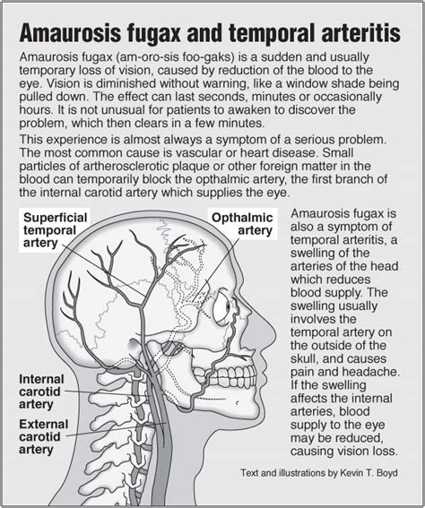 Amaurosis fugax and temporal arteritis – PointFinder Health Infographics