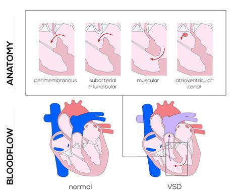 Congenital Defects Tutorial - Congenital Heart Defects | Atlas of Human Cardiac Anatomy