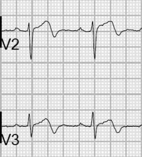 Wellens Syndrome • LITFL Medical blog • ECG Library Eponym | Syndrome ...