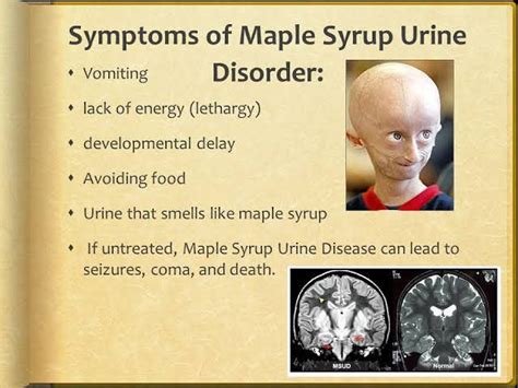 Maple syrup urine disease symptoms - MEDizzy