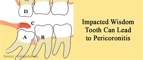 Wisdom Teeth - Symptoms, Signs, Complications & Treatment