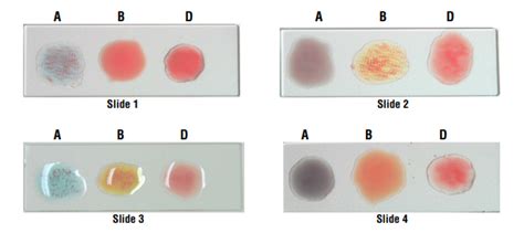 Blood Group Test Procedure, Interpretation, Result and more | Lab Tests ...