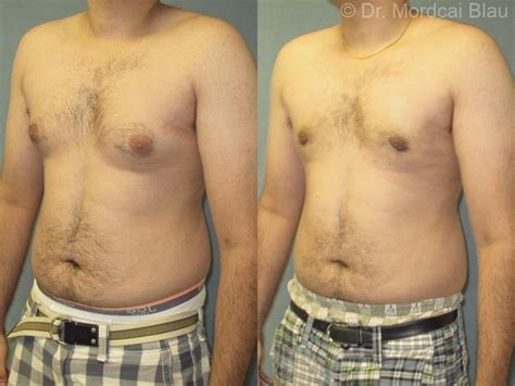 Pseudogynecomastia - Before and After Photos ⋆ Gynecomastia USA