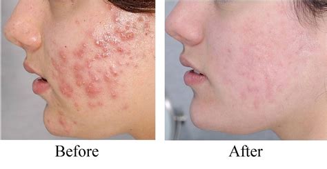 Acne Vulgaris Treatment Service, Acne Treatment Services - Agarwal Hair & Laser Clinic ...