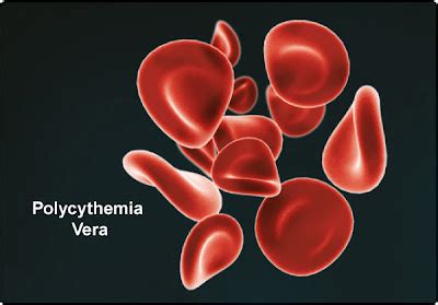 What Is Polycythemia Vera? | Health Food Nutrition