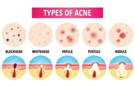 Acne: Causes, Symptoms, Treatments & Prevention Tips Acne: Causes, Symptoms, Treatments ...