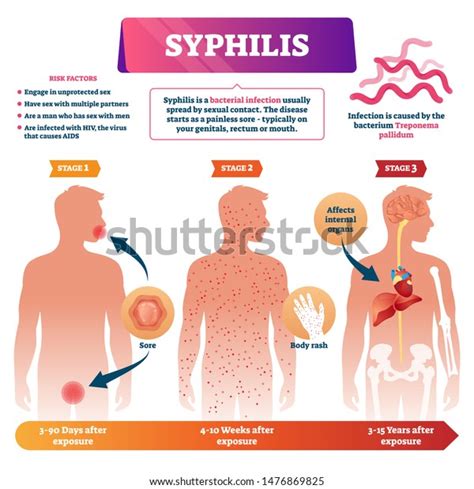 Syphilis Vector Illustration Labeled Sexual Infection Stock Vector ...