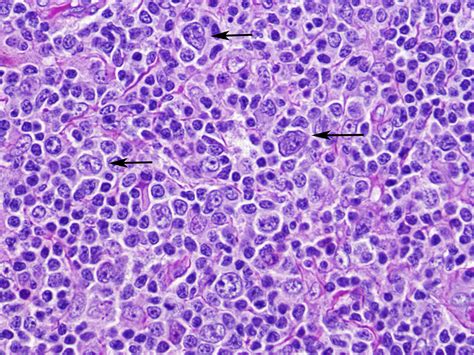 Hodgkin Lymphoma Pathology Outlines