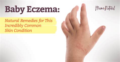 Baby Eczema: Natural Remedies for This Common Skin Condition