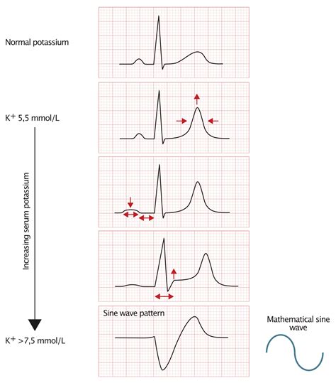 ECG changes due to electrolyte imbalance (disorder) – Cardiovascular Education