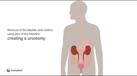 Creation of urostomy by removing bladder, urethra | Ostomy surgery | Coloplast India - YouTube