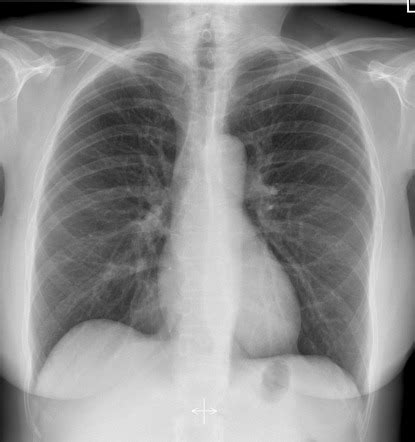 Chest (PA view) | Radiology Reference Article | Radiopaedia.org