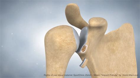 Animation Latarjet procedure - MedicalGraphics