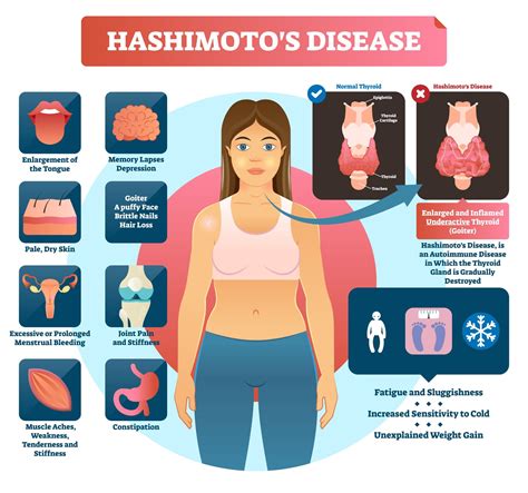 Pathophysiology, Clinical Presentation and Diagnosis | Hashimoto's Disease