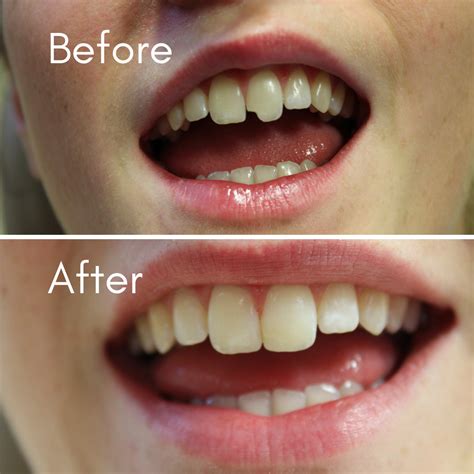 Broken Teeth |Chipped Teeth | Cracked Tooth Repair | General Dentistry