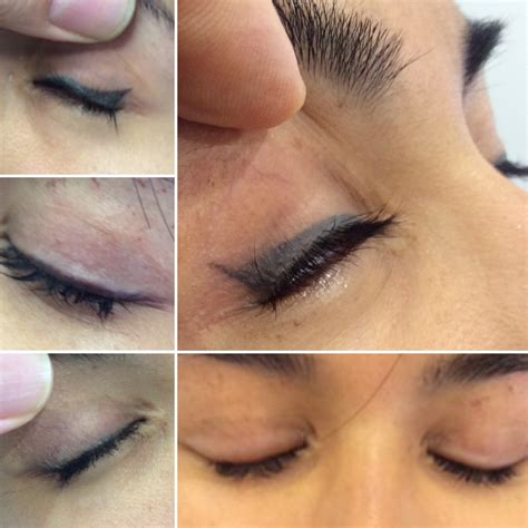 Eyeliner Tattoo Removal Process and Success