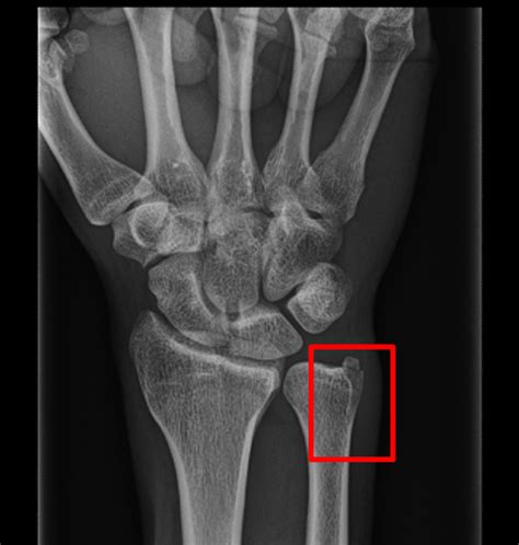 Ulnar Styloid Fracture Treatment | Symptoms | Healing Time