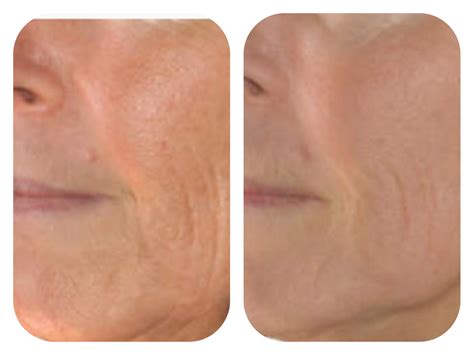 Micro-Needling with RF - Advanced Skin Fitness Dallas