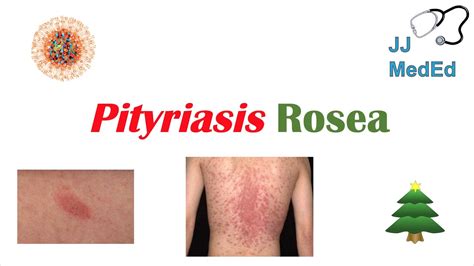 Introduction to Pityriasis Rosea | Possible Causes, Symptoms and ...