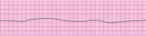 What are the Two Non-Shockable Rhythms in Cardiac Arrest? – Free CPR ...