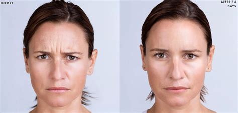 Xeomin Charlotte, NC | Frown Line, Crows Feet, Wrinkle Treatment