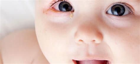 Infant Pink Eye: When To Seek Medical Attention: Pediatrician's Advice