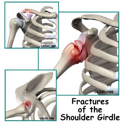 Physical Therapy in our clinic for Shoulder Pain - Adult Fractures