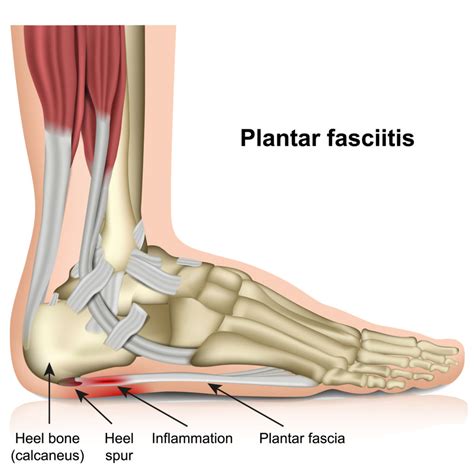 Does Dry Needling work for Plantar Fasciitis? - Acupuncture , Dry ...