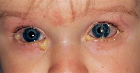 CPD module: Conjunctivitis | Nursing in Practice