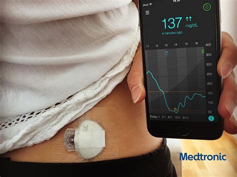 All About the Medtronic Guardian Connect Continuous Glucose Monitor (CGM) – Diabetes Daily