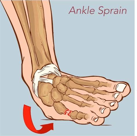 Ankle Sprain – Wellness Clinic