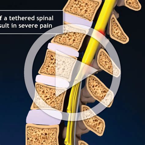 Tethered Cord Syndrome with Surgical Repair - TrialExhibits Inc.