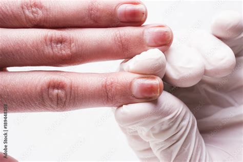 Onycholysis isolated on white background. Mechanical damage to the nail ...