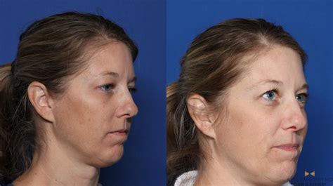 Sciton Laser Before & After Photos Patient 334 | Fort Worth, Texas ...