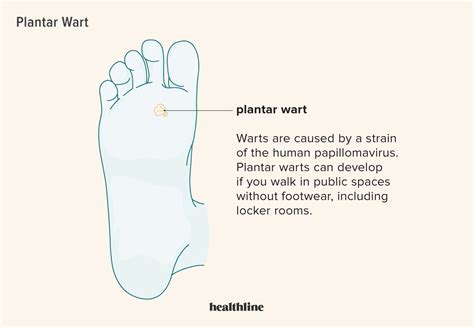 Plantar Wart: What is it, Symptoms, Treatment, and More