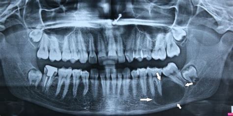 Nuface - Cyst and Tumor of Jaw and Face