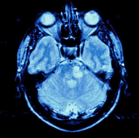 Mri Scan Of A Brain With Multiple Sclerosis Photograph by Science Photo ...