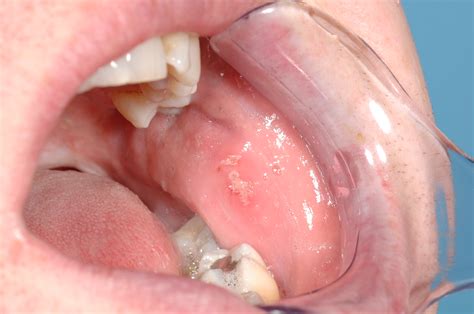 Oral mucosal lesions