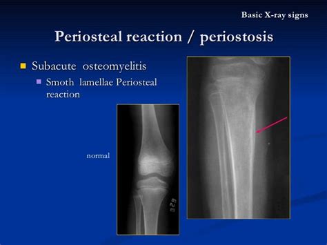 Les 107 meilleures images du tableau OSTEOMYELITIS sur Pinterest | Radiologie, Médecine et Os