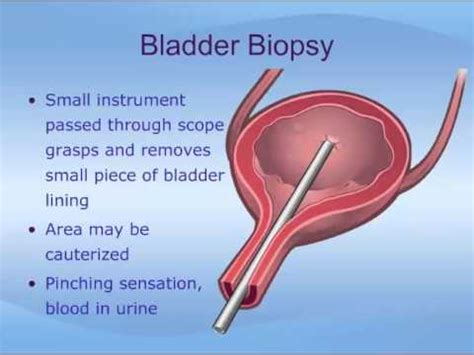 Cystoscopy - YouTube