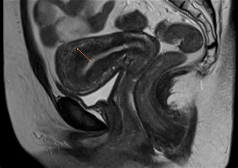 Ultimate Radiology : Adenomyosis of Uterus