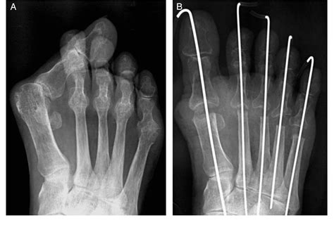 Midterm results of resection arthroplasty for forefoot deformities in ...