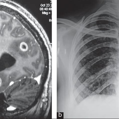 (PDF) Multiple ring-enhancing lesions of the brain