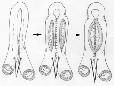 A Comprehensive Review of Strictureplasty Techniques in Crohn’s Disease ...