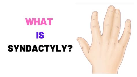 WHAT IS SYNDACTYLY? - WEBBED FINGERS, Causes, Symptoms, Treatment, Surgery - YouTube