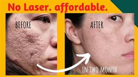 【Affordable】Finally I found something that works for my acne scars【acne ...