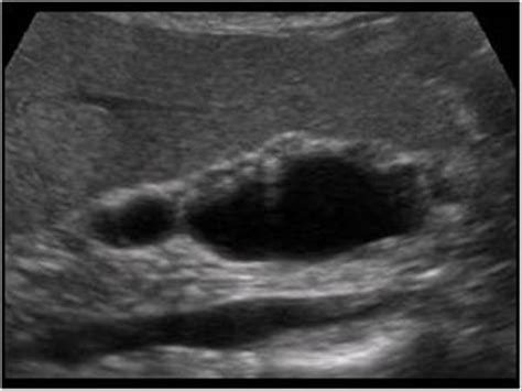 Abdomen and retroperitoneum | 1.2 Gallbladder and bile ducts : Case 1.2 ...