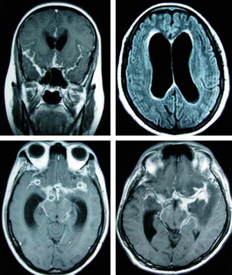 Tuberculous meningitis: many questions, too few answers - The Lancet Neurology